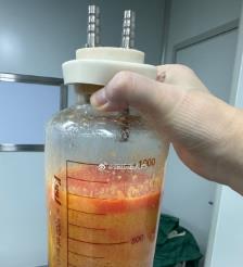 如东水动力吸脂手术要做多久？